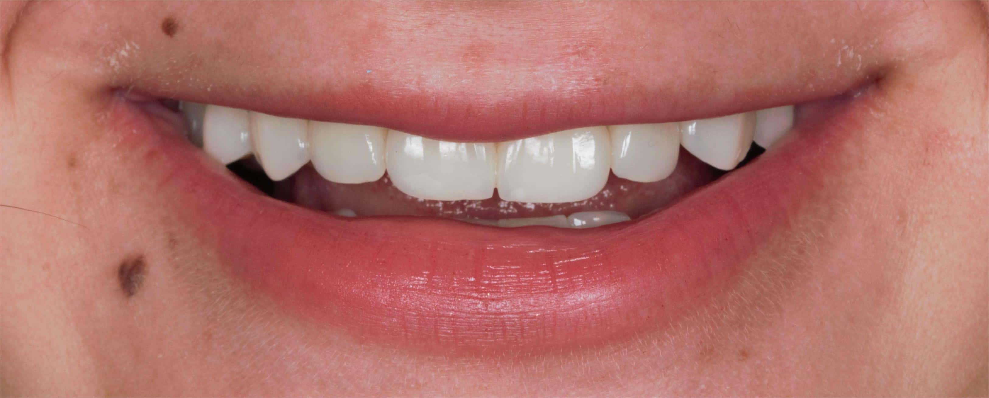 Dental transformation after treatment at Beyond Smiles Dental Clinic