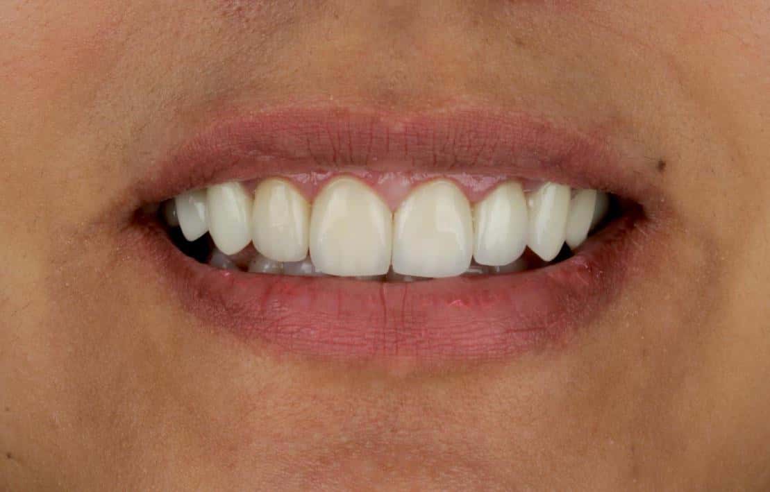 Dental transformation after treatment at Beyond Smiles Dental Clinic