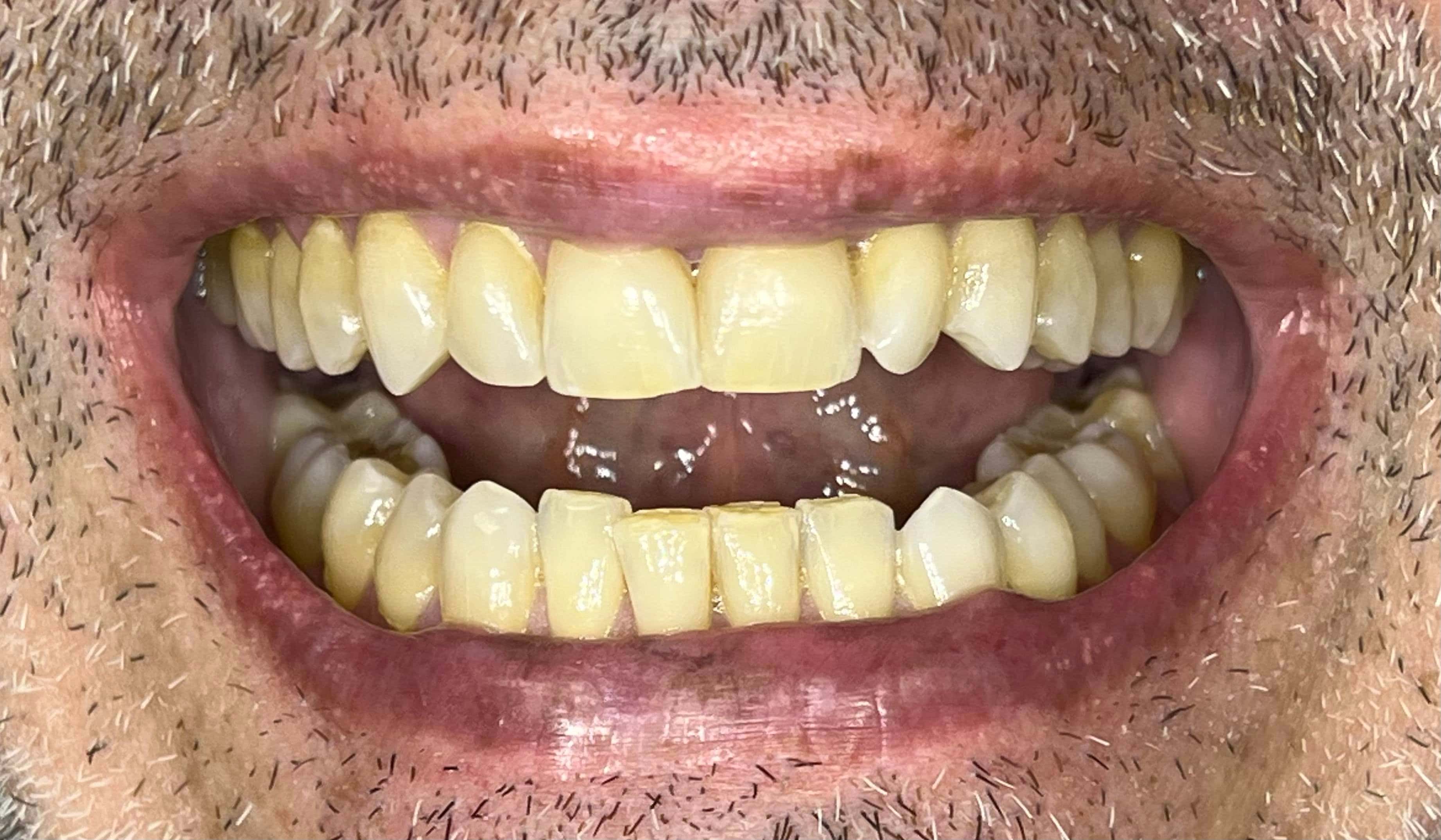 Dental transformation before treatment at Beyond Smiles Dental Clinic