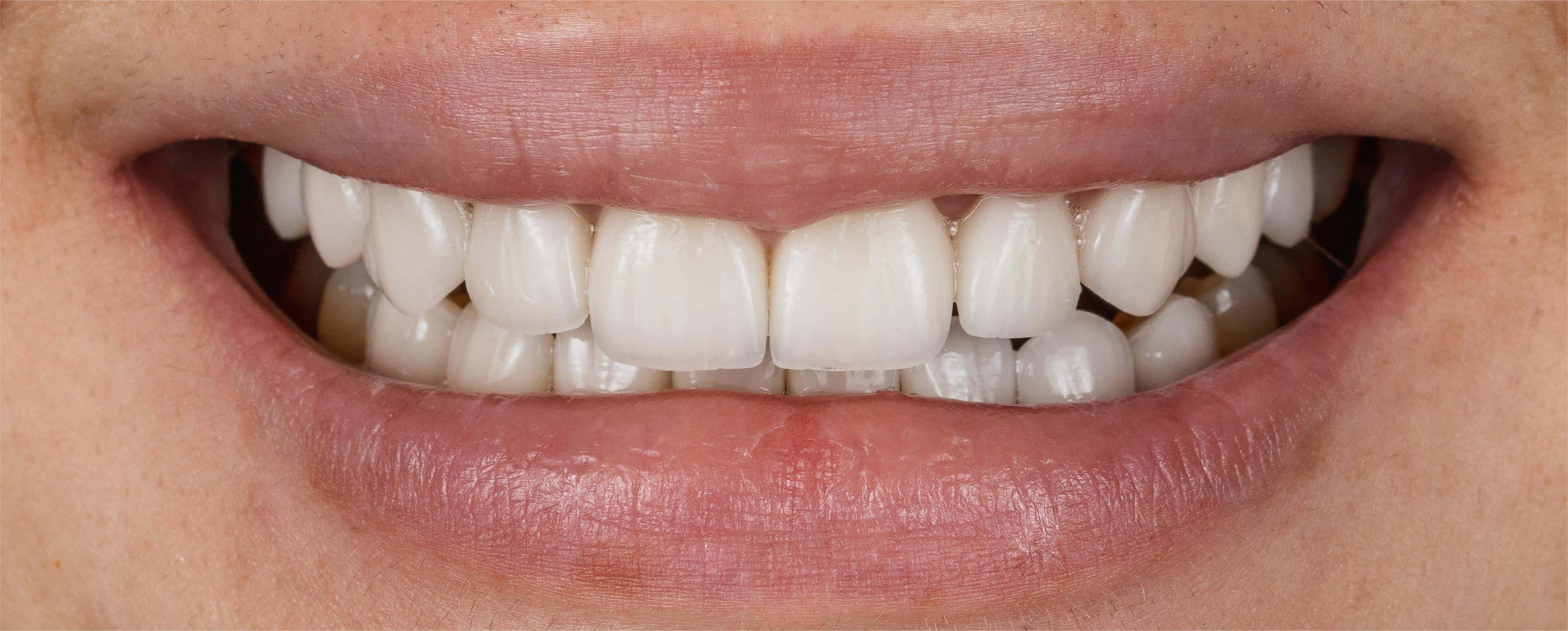 Dental transformation after treatment at Beyond Smiles Dental Clinic