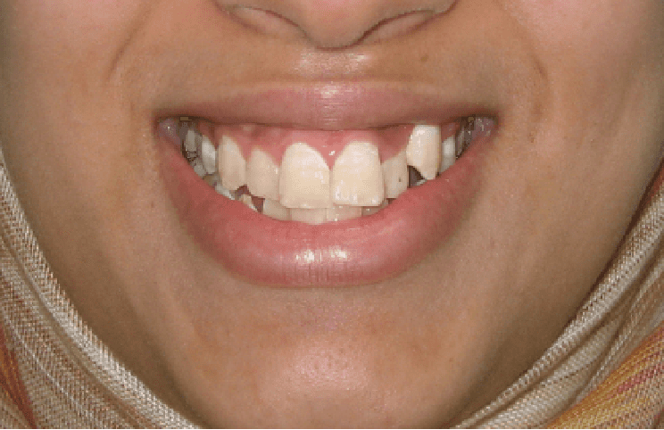 Dental transformation before treatment at Beyond Smiles Dental Clinic