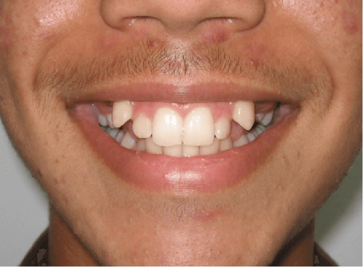 Dental transformation before treatment at Beyond Smiles Dental Clinic
