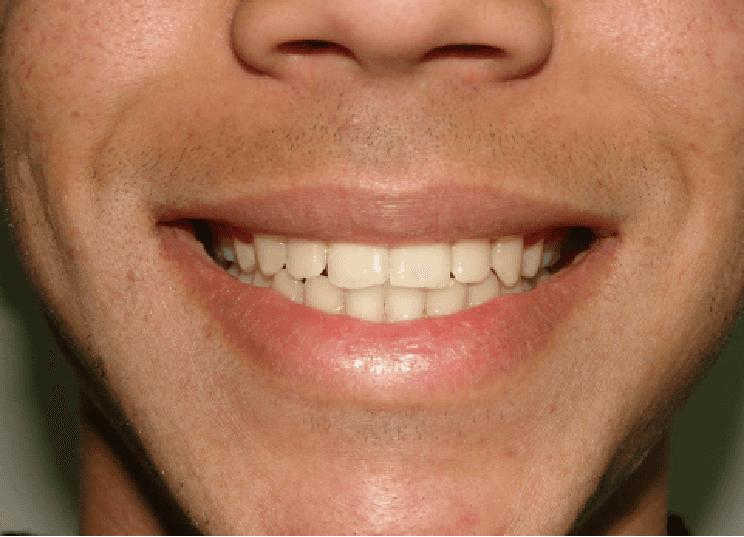 Dental transformation after treatment at Beyond Smiles Dental Clinic
