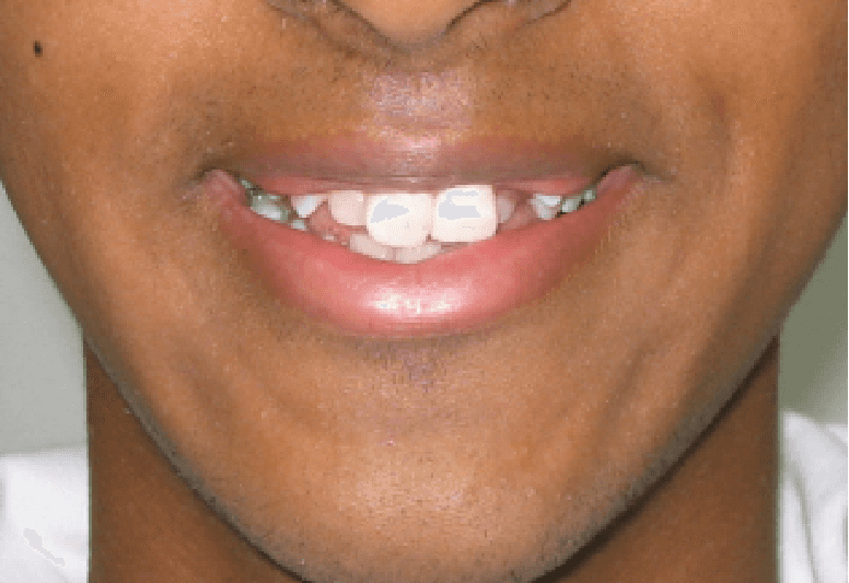 Dental transformation before treatment at Beyond Smiles Dental Clinic