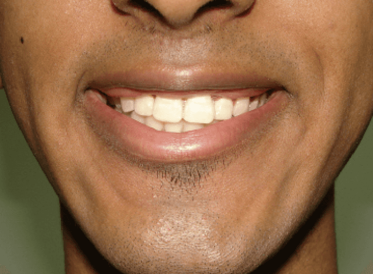Dental transformation after treatment at Beyond Smiles Dental Clinic
