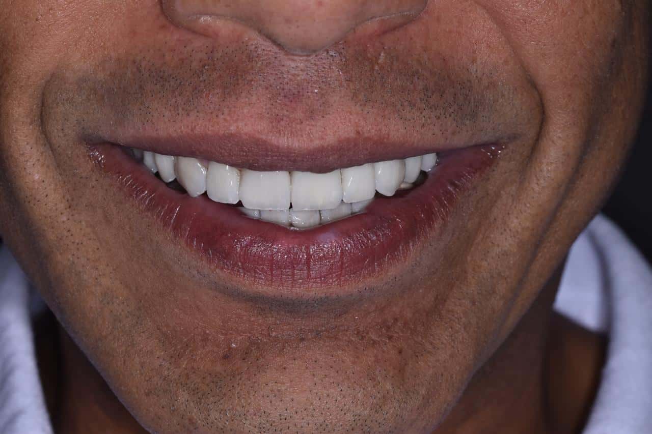 Dental transformation after treatment at Beyond Smiles Dental Clinic